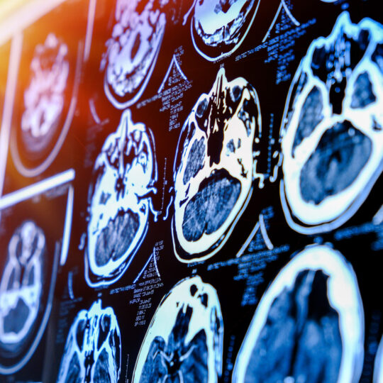 Schlaganfall CT
